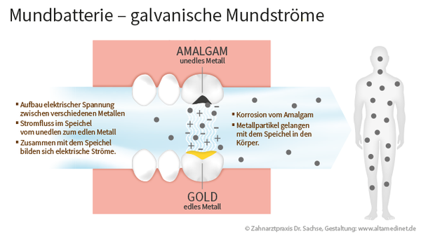 Amalgamsanierung Mundbatterie 