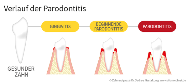 Parodontitis